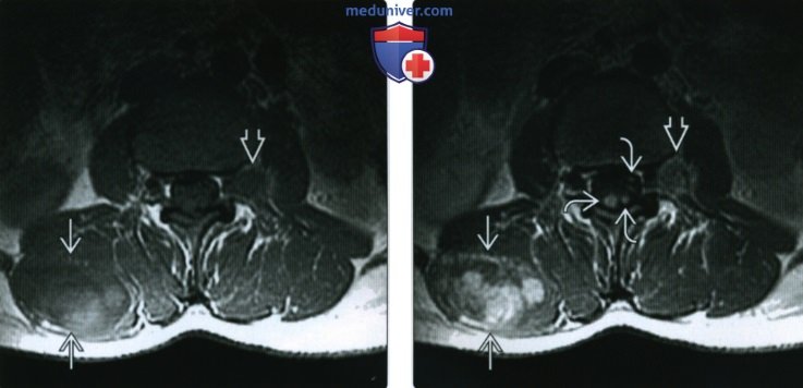 Рентгенограмма, КТ, МРТ, УЗИ при злокачественной опухоли оболочки периферических нервов (ЗООПН)