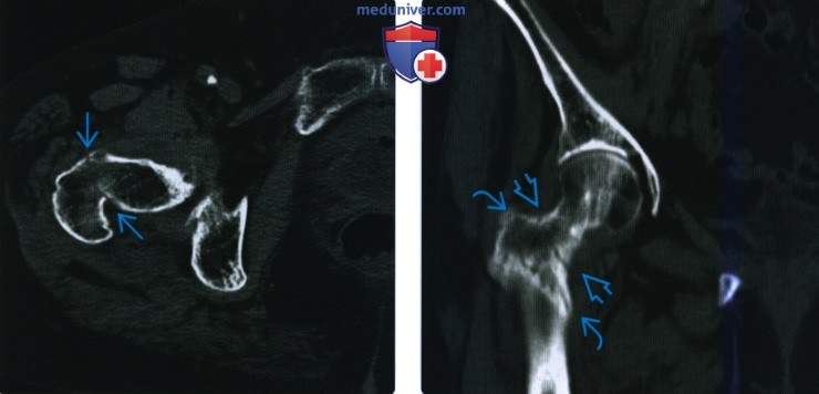 Рентгенограмма, КТ, МРТ при вертельном и межвертельном переломе бедренной кости