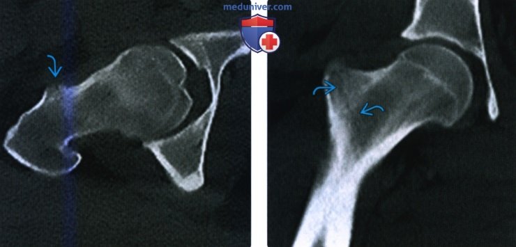 Рентгенограмма, КТ, МРТ при вертельном и межвертельном переломе бедренной кости
