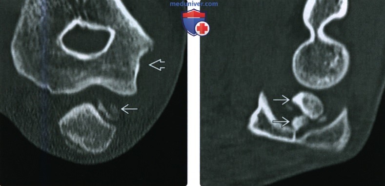 Рентгенограмма, КТ, МРТ при вывихе предплечья