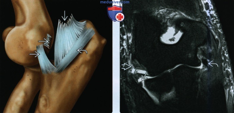 Рентгенограмма, КТ, МРТ при вывихе предплечья