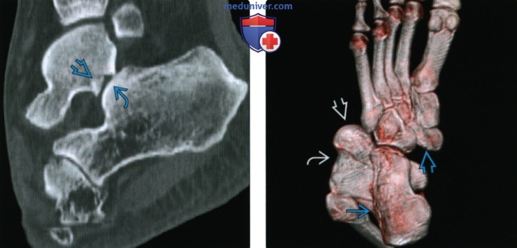 Рентгенограмма, КТ, МРТ при вывихе таранной кости