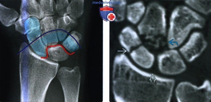 Рентгенограмма, КТ, МРТ при вывихе запястья
