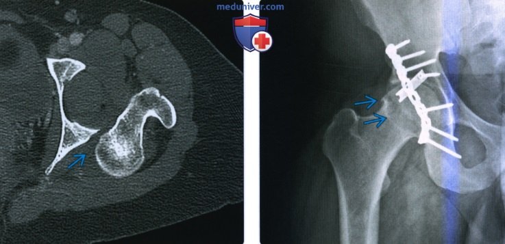 Рентгенограмма, КТ, МРТ при вывихе бедра
