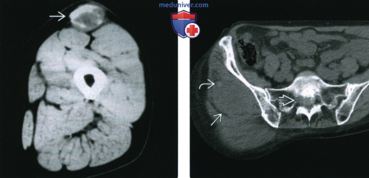 Рентгенограмма, КТ, МРТ при внескелетной остеосаркоме