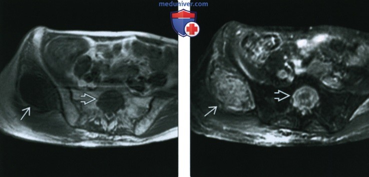 Рентгенограмма, КТ, МРТ при внескелетной остеосаркоме