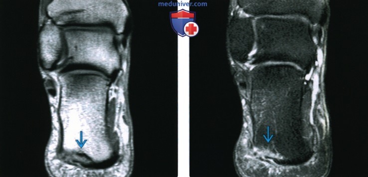 Рентгенограмма, КТ, МРТ при внесуставном переломе пяточной кости