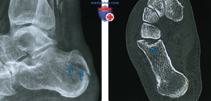 Рентгенограмма, КТ, МРТ при внесуставном переломе пяточной кости