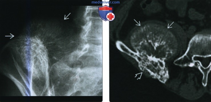 Рентгенограмма, КТ, МРТ при внутрикостной гемангиоме