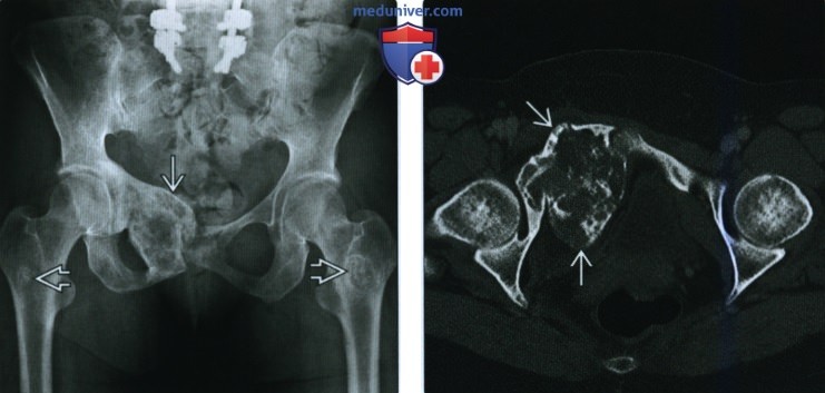 Рентгенограмма, КТ, МРТ при внутрикостной гемангиоме