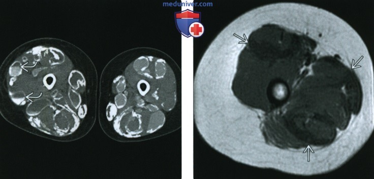 Рентгенограмма, КТ, МРТ при воспалительной миопатии