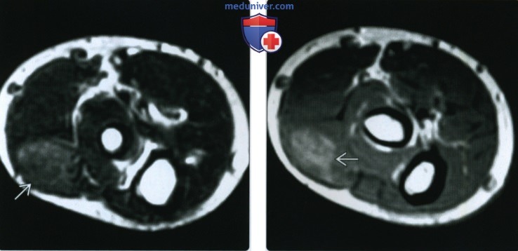 Рентгенограмма, КТ, МРТ при воспалительной миопатии