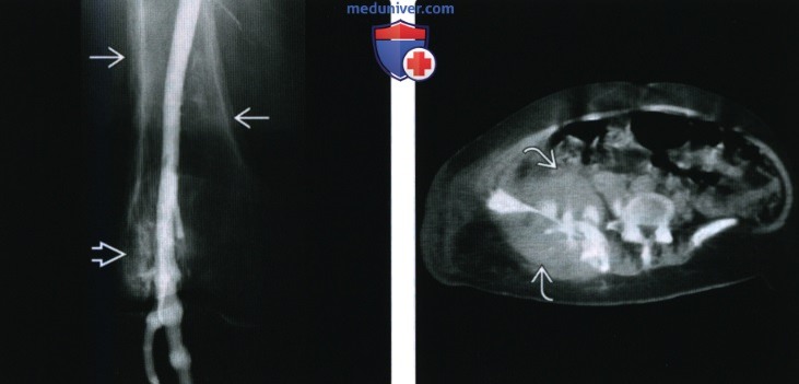 Рентгенограмма, КТ, МРТ при вторичной остеосаркоме