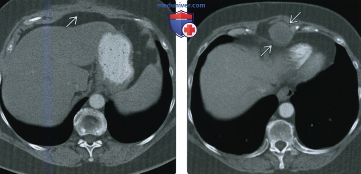 Рентгенограмма, КТ, МРТ при вторичной остеосаркоме