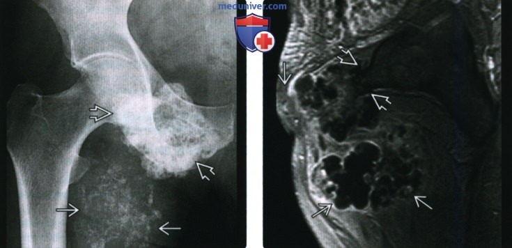 Рентгенограмма, КТ, МРТ при хондросаркоме