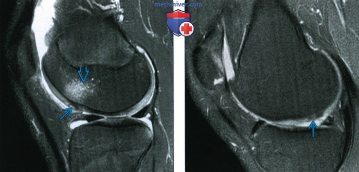 Рентгенограмма, КТ, МРТ при хрящевой травме колена