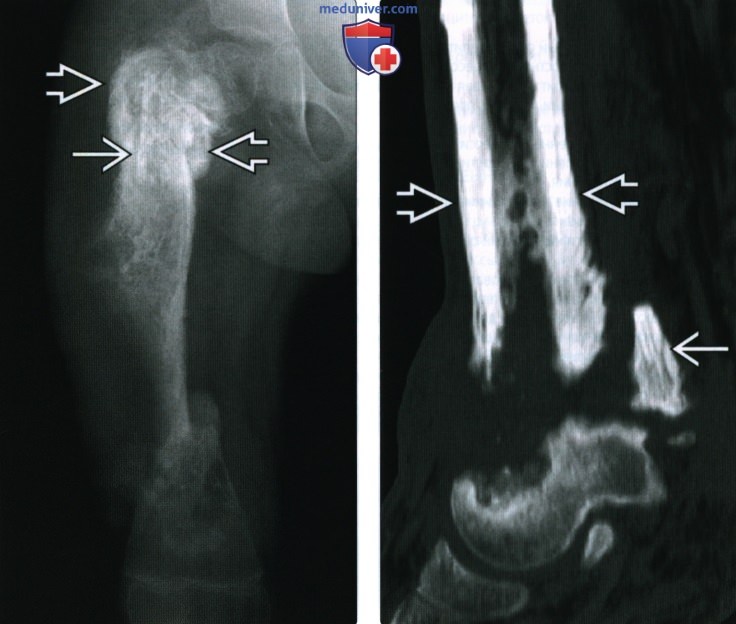 Рентгенограмма, КТ, МРТ при хроническом остеомиелите