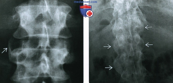 Рентгенограмма, КТ, МРТ при хроническом реактивном артрите