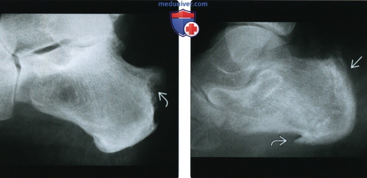 Рентгенограмма, КТ, МРТ при хроническом реактивном артрите