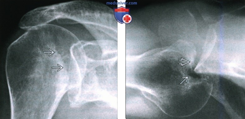 Рентгенограмма, КТ, МРТ при заднем вывихе плеча