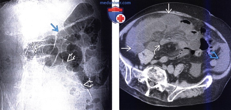 Рентгенограмма, КТ при непроходимости тонкой кишки