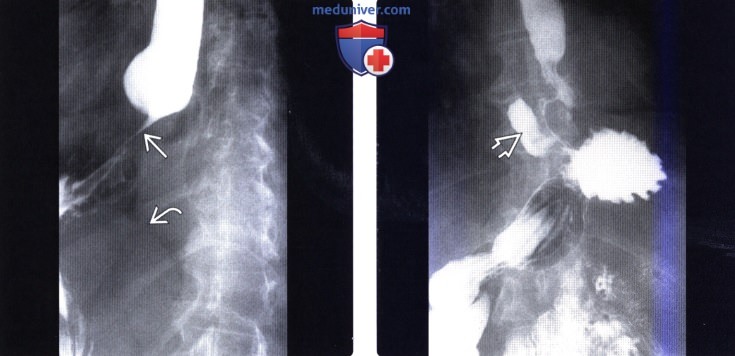 Рентгенограмма, КТ при осложнении фундопликации