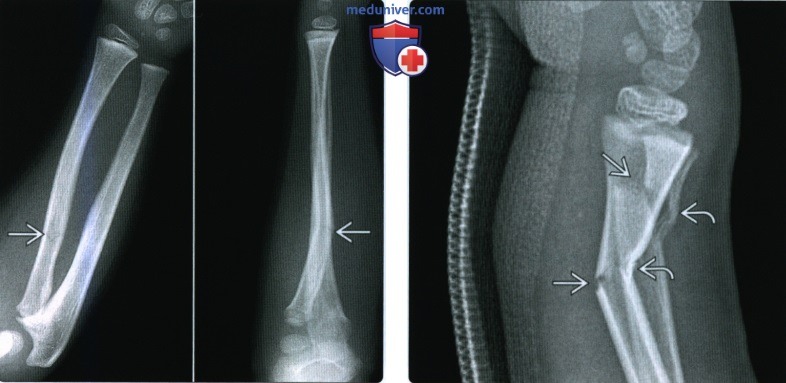 Рентгенограмма, КТ при переломе костей предплечья