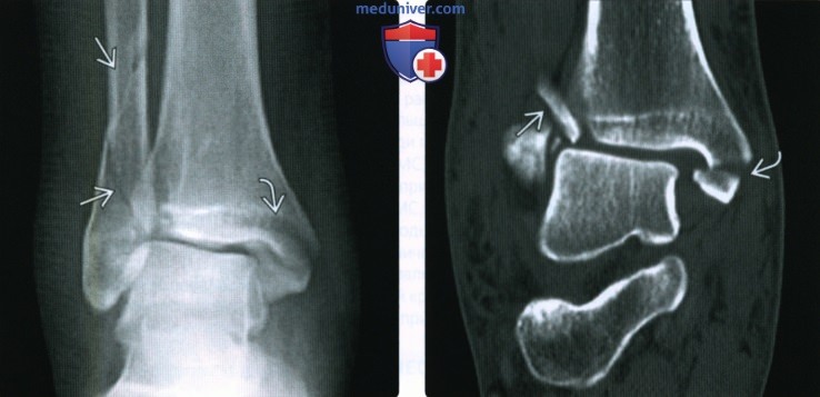 Рентгенограмма, КТ при переломе лодыжки