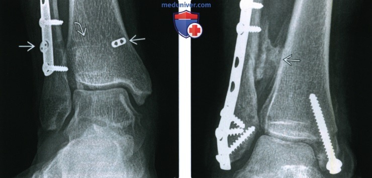 Рентгенограмма, КТ при переломе лодыжки