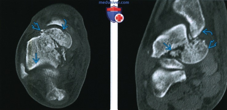 Рентгенограмма, КТ при переломе шейки и головки таранной кости