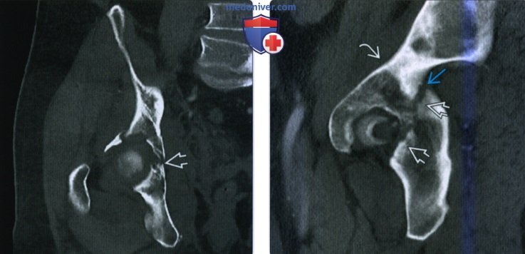 Рентгенограмма, КТ при переломе вертлужной впадины