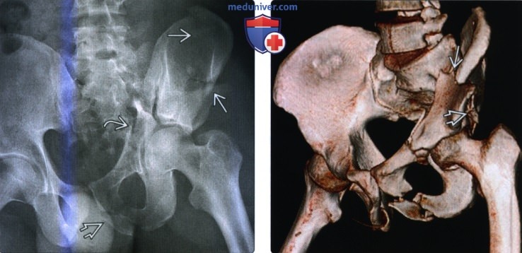 Рентгенограмма, КТ при переломе вертлужной впадины
