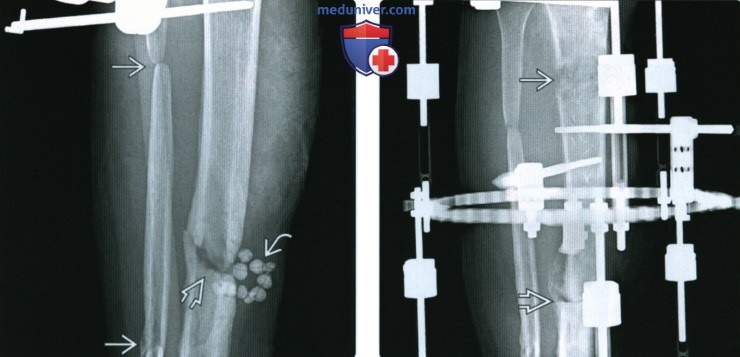Рентгенограмма, КТ при переломе диафизов большеберцовой и малоберцовой костей