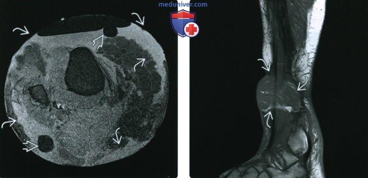 Рентгенограмма, КТ при переломе диафизов большеберцовой и малоберцовой костей