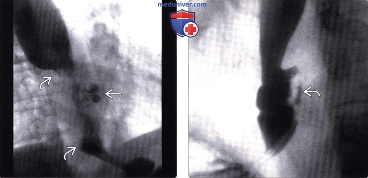 Рентгенография (эзофагография), КТ при перфорации пищевода