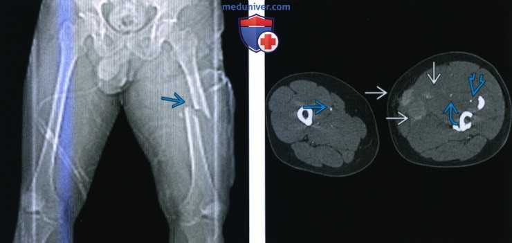 Рентгенограмма, КТ при подвертельном переломе и переломе диафиза бедренной кости