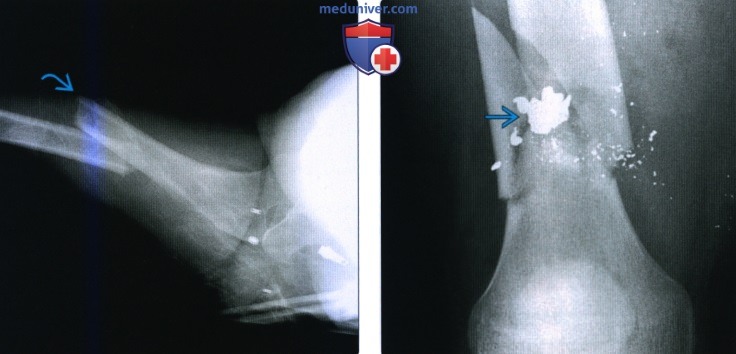 Рентгенограмма, КТ при подвертельном переломе и переломе диафиза бедренной кости
