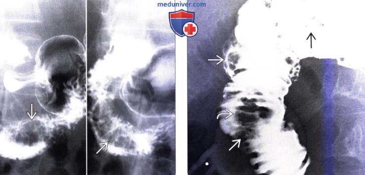 Рентгенограмма, КТ при полипе двенадцатиперстной кишки
