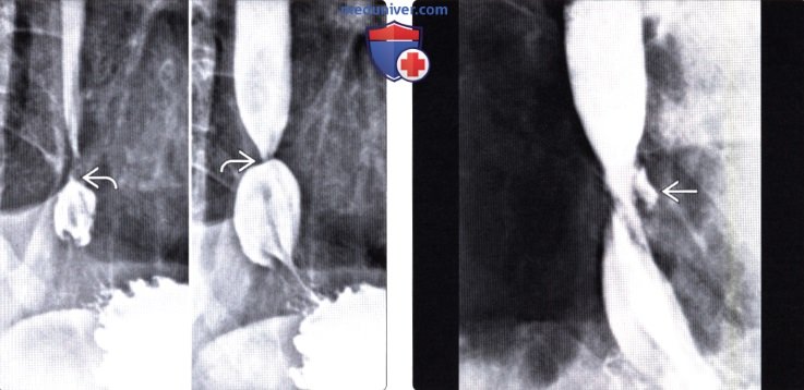 Рентгенограмма, КТ при рефлюкс-эзофагите