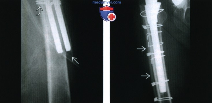 Рентгенограмма, КТ при ревизионной артропластике