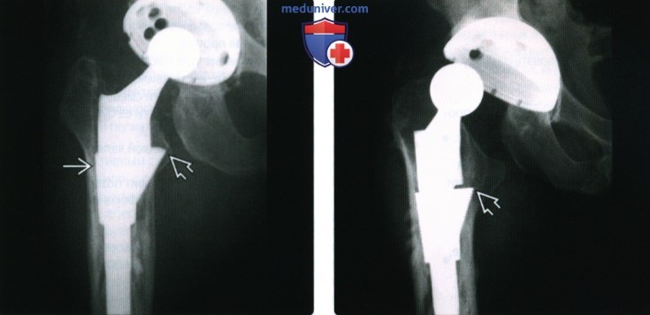Рентгенограмма, КТ при ревизионной артропластике
