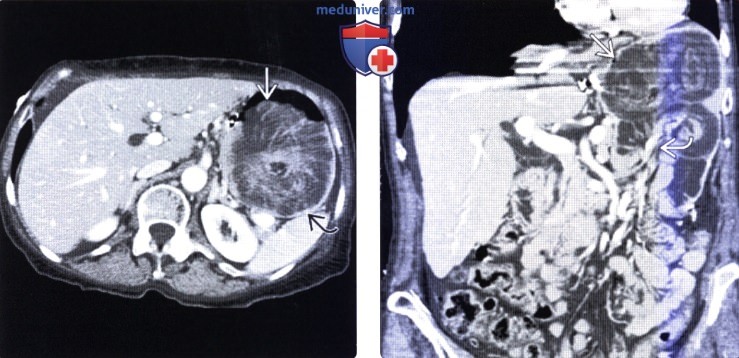 Рентгенография, КТ при резекции желудка по Бильрот