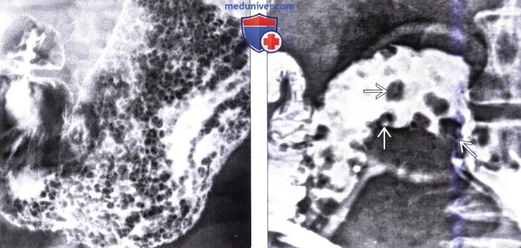 Рентгенограмма, КТ при семейном полипозе (синдроме Гарднера)