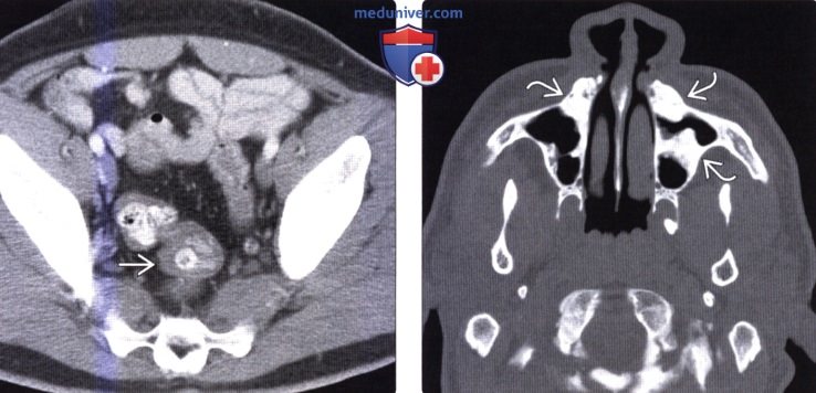 Рентгенограмма, КТ при семейном полипозе (синдроме Гарднера)