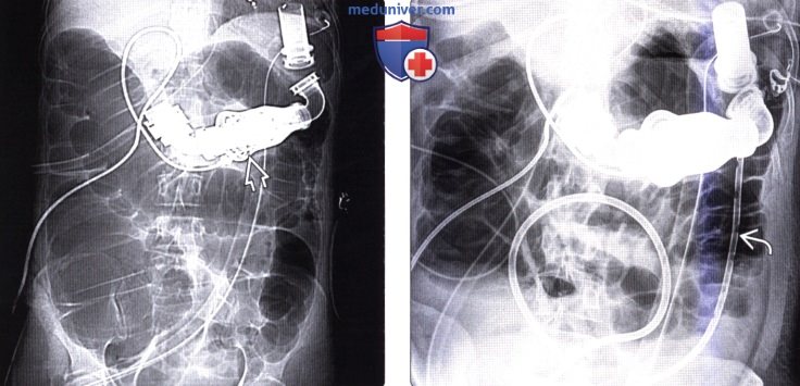 Рентгенограмма, КТ при синдроме Огилви (илеусе толстой кишки)