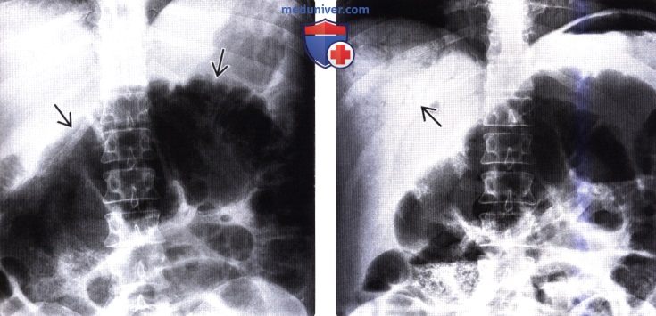 Рентгенограмма, КТ при синдроме Огилви (илеусе толстой кишки)