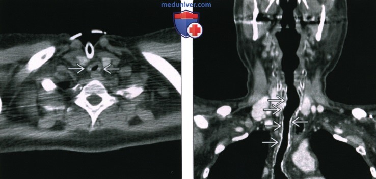 Рентгенограмма, КТ при стенозе подскладочного пространства гортани и трахеи