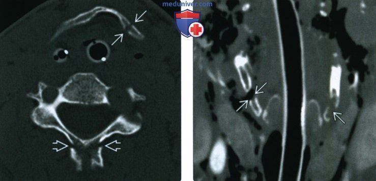 Рентгенограмма, КТ при травме гортани
