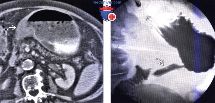 Рентгенограмма, КТ, УЗИ при метастазе в желудок и лимфоме желудка