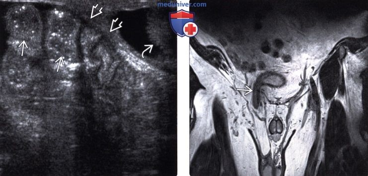 Рентгенограмма, КТ, УЗИ при паховой грыже